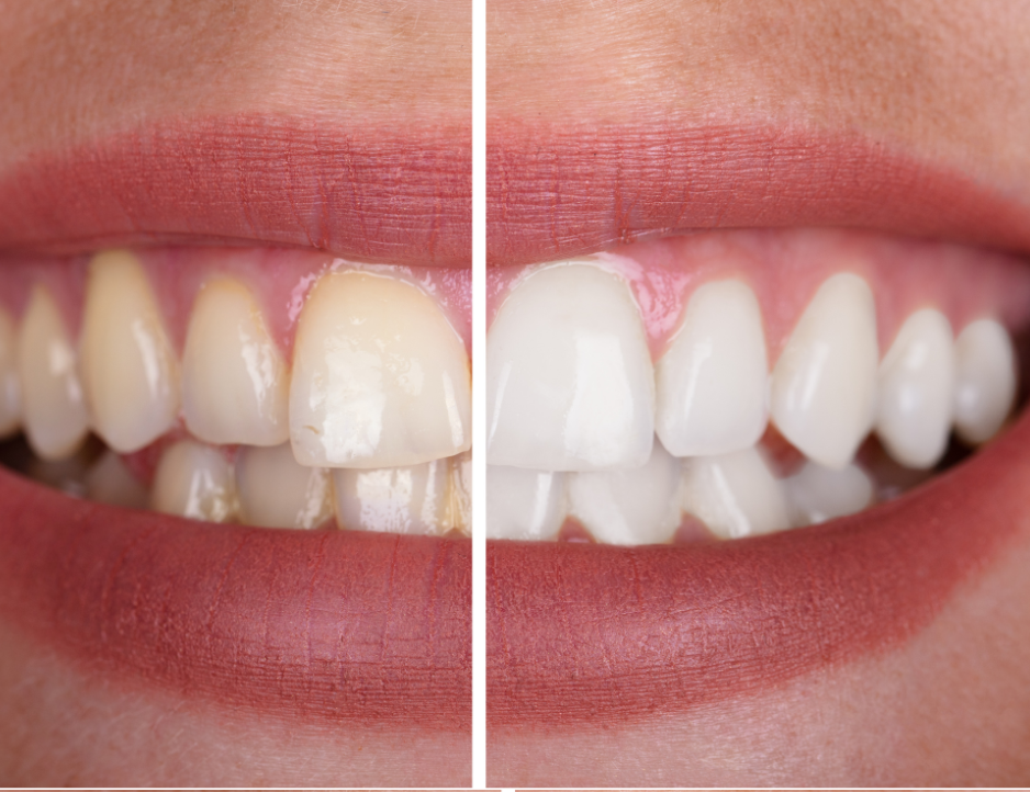 Happy Smile Pro before and after